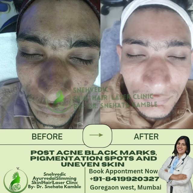 Real Skin. Real Progress. Real Results. ✨

Acne can leave behind more than active breakouts — post-a