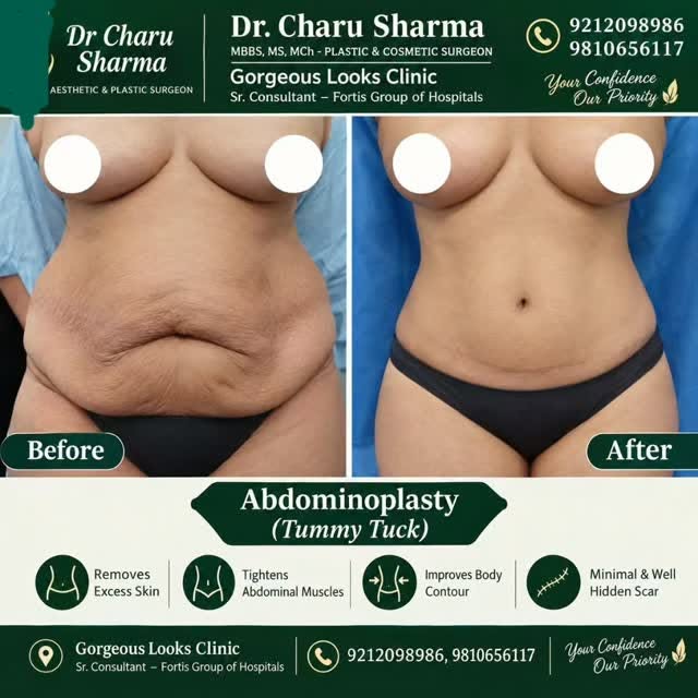 #Abdominoplasty #TummyTuck  #bodyContouring #MommyMakeover  #FlatTummy BodyTransformation AestheticS
