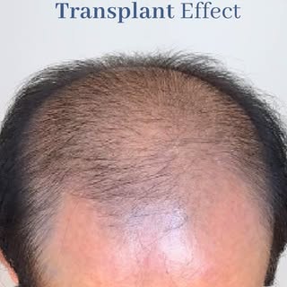 ⚠️ Warning: Hair Transplant Side Effects May Include...

✔️ Fuller hair 
✔️ A natural-looking hairli
