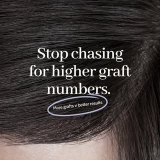 Don't be fooled by bigger graft numbers.

One of the biggest myths in hair transplantation is that m