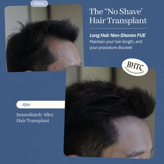 Hair transplant... without shaving your head? Yes, it’s possible. 👀

Our Long Hair Non-Shaven FUE t
