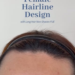 A hairline can make all the difference. ✨ Watch how Dr. Abner restores this female hairline with a p