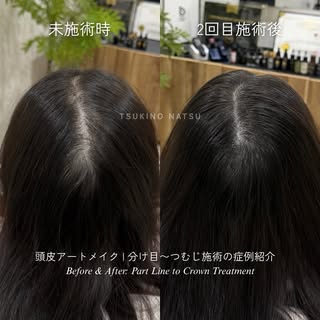 つむじ割れに悩む方は見て欲しい！
@artmake.smp_natsu 👈🏻他にも症例たくさん🔍✨
ストーリーのハイライトに症例が溢れています🙂‍↕️

分け目からつむじまで、
広範囲に頭皮ア