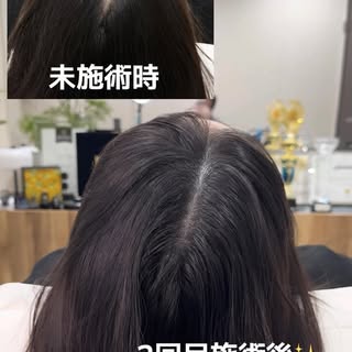 頭皮アートメイクで透け感を自然にカバー🌿

頭皮アートメイクによって、
髪が抜けたり、生えにくくなったりすることはありません。

髪を生やす施術ではありませんが、
頭皮の透け感を目立ちにくくし、
見