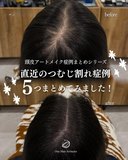 「つむじが割れて、頭皮が目立つ…」

そんなお悩みに対する
頭皮アートメイクの症例を5つまとめました🌿

同じ「つむじ割れ」でも、
毛量や髪の太さ、つむじの向きによって
透け方や見え方は一人ひとり異