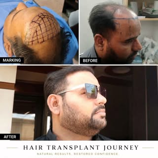 ✨ Hair Transplant Journey ✨

Transform your look. Restore your confidence.

At Skin Bliss Aesthetics