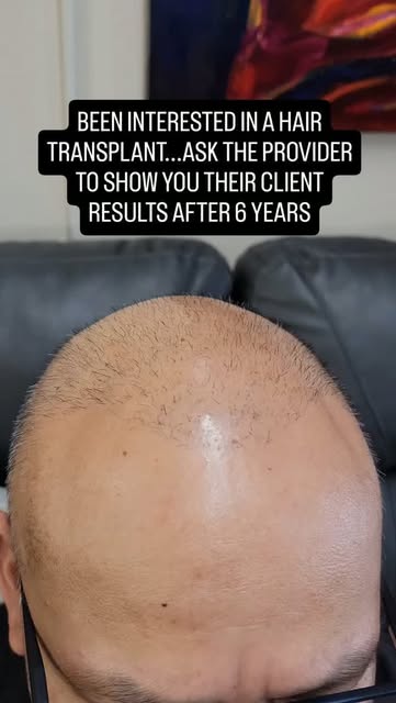 Been interested in a hair transplant? Sounds good......Been thinking about scalp micropigmentation i