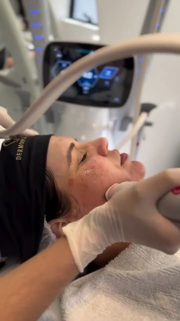 Tecnologia coreana para redefinir o contorno facial, elevar suavemente a sobrancelha e estimular col