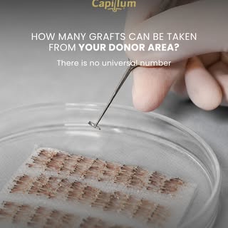 A successful hair transplant isn’t about extracting the highest number of grafts. It’s about using t