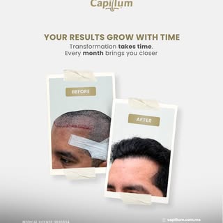 Hair transplant results develop gradually as the transplanted follicles complete their natural growt