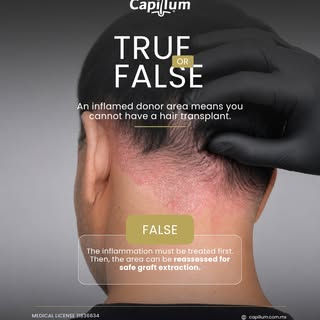 Inflammation in the donor area does not automatically rule out a future hair transplant.

The cause 