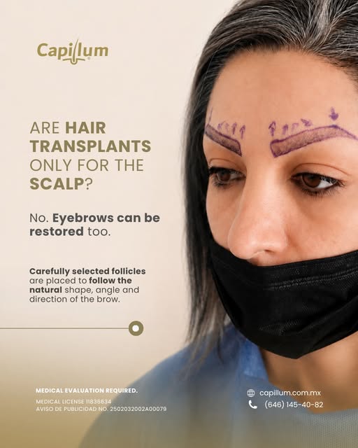Eyebrow restoration requires careful planning of shape, density and symmetry to create a result that