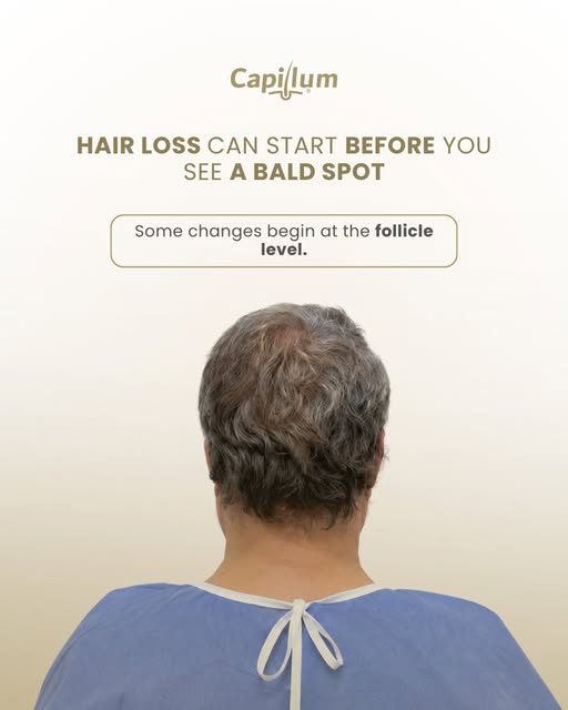 Hair loss doesn’t always begin with a visible bald spot.

In androgenetic alopecia, follicles can gr