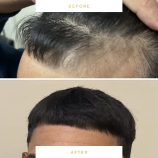 Progress in motion. ✨ See the incredible change in our client’s hairline and overall hair appearance