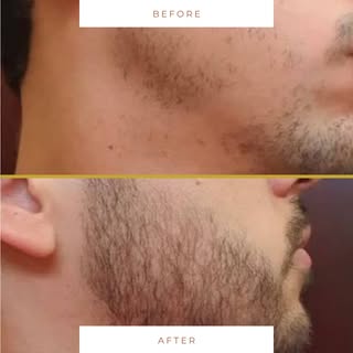 By utilizing regenerative cell signaling, this facial hair treatment directly reactivates dormant fo