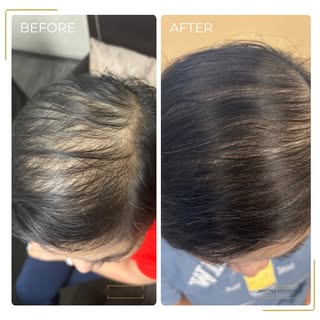 Before: Active thinning along the hair matrix, characterized by miniaturized strands and sluggish fo