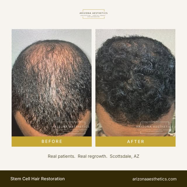 Coverage where there wasn't any. Same patient, same crown, months of treatment apart. Stem cell ther