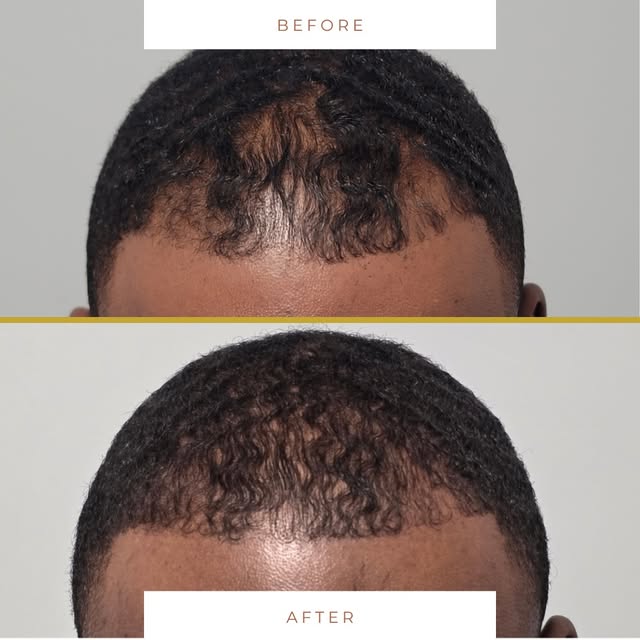 Real science. Real hair growth. Zero downtime. 🧬👇
A quick look at what’s possible when you target 
