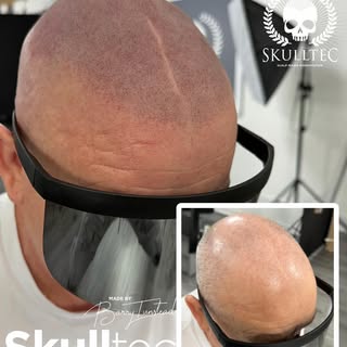 We just love a natural scar with SMap#Most natural results in 🏴󠁧󠁢󠁳󠁣󠁴󠁿 it’s all about that hai