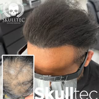 Most natural results in 🏴󠁧󠁢󠁳󠁣󠁴󠁿 it’s all about that hairline… 

If you are interested in hear