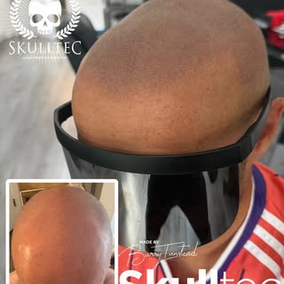 All the way from USA 🇺🇸 for scalp micro pigmentation

Most natural results in 🏴󠁧󠁢󠁳󠁣󠁴󠁿 it’s 