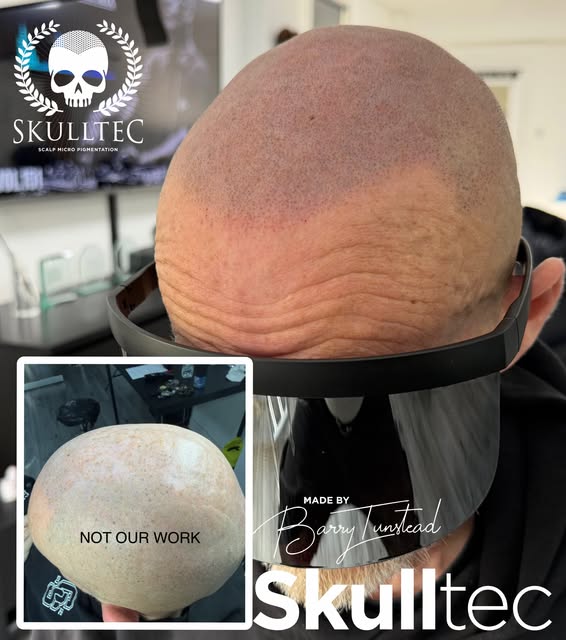 This poor gentleman had a treatment carried out by another provider that left him with a botched job