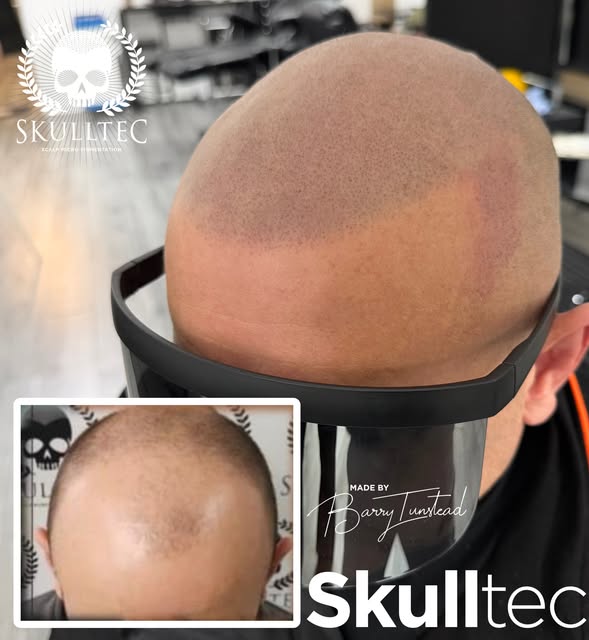 Most natural results in 🏴󠁧󠁢󠁳󠁣󠁴󠁿 it’s all about that hairline… 

If you are interested in hear