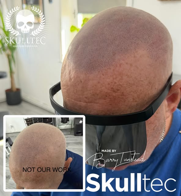 Laser and repair work… sadly it’s more common these days where clients are coming to the clinic with