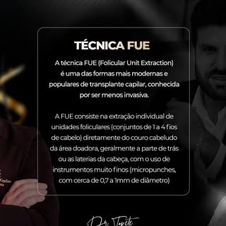 Quando se fala em transplante capilar, a técnica FUE (Folicular Unit Extraction) se destaca como uma