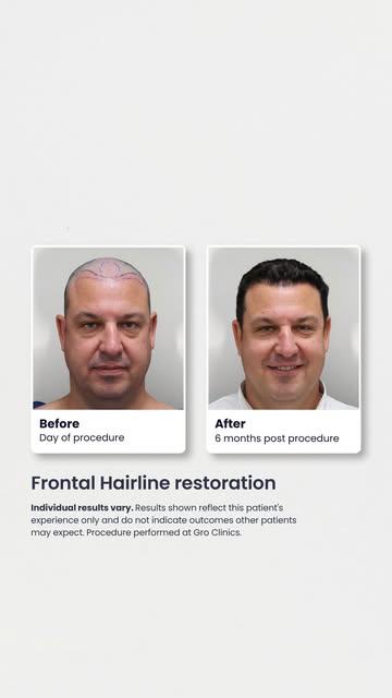 Six months post-procedure, here’s a check-in on how this patient’s frontal hairline is progressing.
