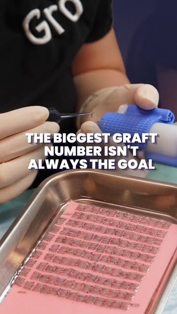 A bigger graft number isn’t automatically a better plan.

Dr Anwar explains why. Graft numbers are o