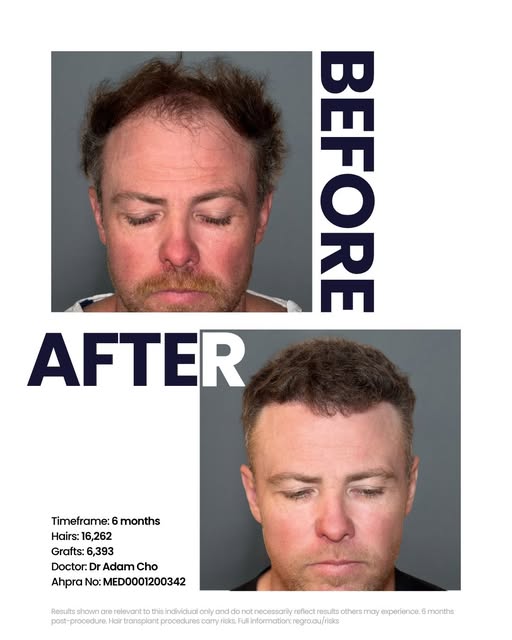 Six months in - an early checkpoint in this patient’s timeline.

This case started with recession th