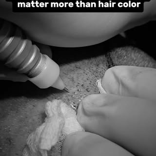 🚫 Myth: White hair can’t be transplanted.

✅ Fact: Hair color doesn’t decide whether a graft can be