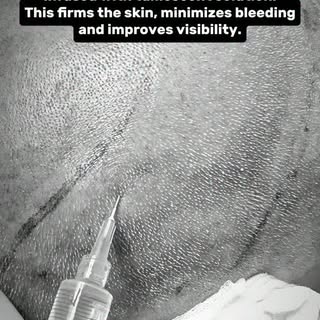 💉 Tumescent Injection: A Crucial Step in Hair Transplant

Before graft extraction begins, the donor