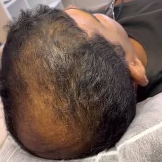 2nd session results 🔥🔥🔥

Worried about hair loss ? 
Looking for a Permanent | Pain free | Non sur