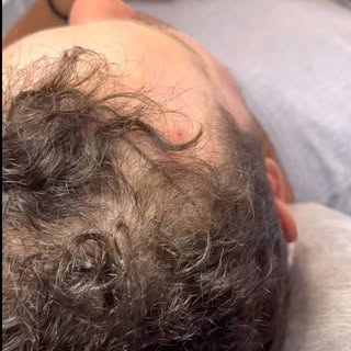 SMP is suitable for all types of hairloss. These results are after only one session to add density t