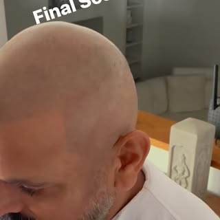 Last session to fix up a previous failed hair transplant and SMP.
I think we’ve made a huge improvem