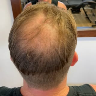 Swipe 👉👉👉👉 for the final result 🔥🔥🔥🔥

Worried about hair loss ? 
Looking for a Permanent | P