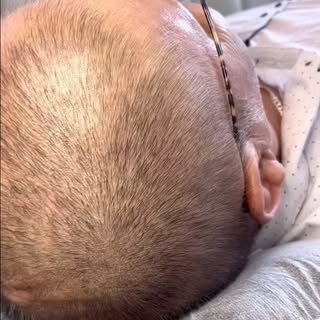 2nd session results 🔥🔥🔥

Worried about hair loss ? 
Looking for a Permanent | Pain free | Non sur