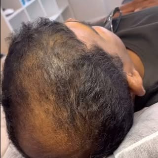 Final healed results 6 weeks after our 1st session.
If you’re worried about thinning hair then SMP i