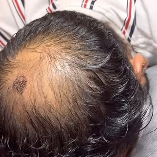 Is hairloss in your crown area concerning you ? Scalp Micro has the solution. Final results 👆👆👆

