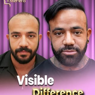 From before to after — a natural transformation with confident results ✨
A stronger hairline, fuller