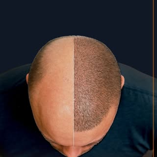 Get the hair you’ve always dreamed of at Rootz Hair Transplant Clinic in Raipur & Jagdalpur 🌱💇‍♂️ 