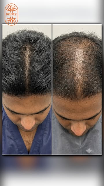 2500 GRAFTS OR 3500 — WHY THE DIFFERENCE?🔥 

Because every patient’s hair is different.
Density, ha