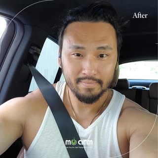 M-shaped hairline FUE hair transplant ✔️
Swipe right for before and after!

M-shape hairline is usua