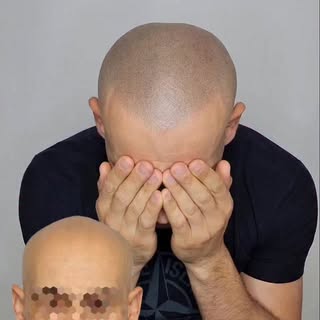 La micropigmentation capillaire, cette solution unique qui met fin à la calvitie !