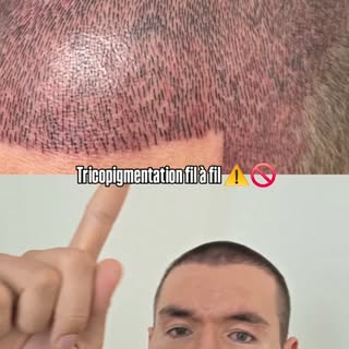 Tricopigmentation "fil à fil" 🚫⚠️ : attention à ce que l'on ne vous montre pas !

Le rendu juste ap