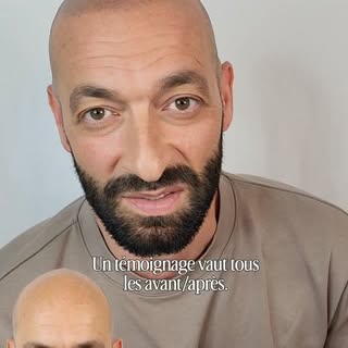 La calvitie vous complexe ? Et si la micropigmentation capillaire était la solution que vous attendi