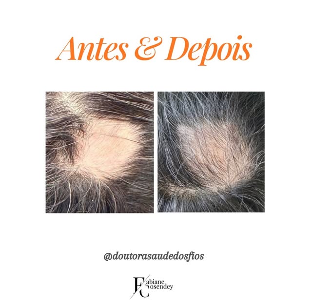 Mais um caso de alopecia areata melhorando em apenas 1 sessão (praticamente 1 mês de tratamento).

R