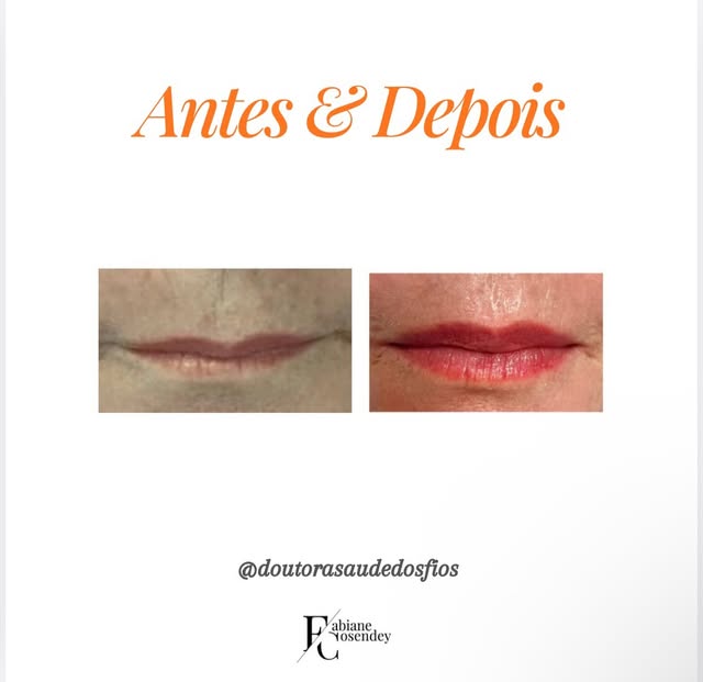 Mais um preenchimento labial que ficou super bonito e natural. Respeitando a individualidade de cada